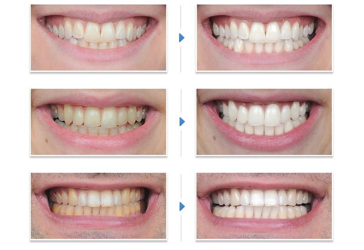 Belissas Teeth Whitening Works